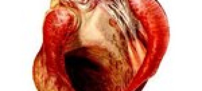 Аневризма сердца: причины, признаки, симптомы, лечение